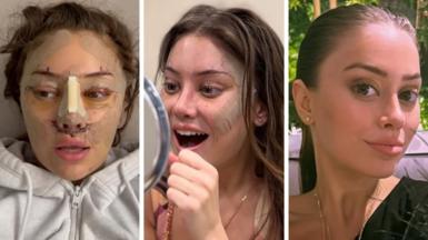 A composite image showing Emily, a woman with long brown hair, in recovery, smiling into a mirror  with sticking plasters still on her face and after fully recovering with no bandages on