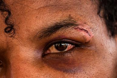 An alleged victim of a scam centre shows a cut above their eye