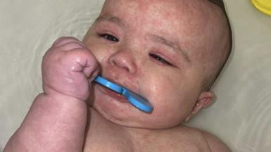 A photo of Kimie with a visible red rash on her body, a common symptom of measles.