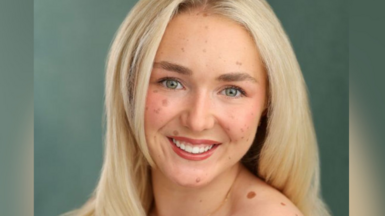 Scarlett Clarke in a head and shoulders photo. She is smiling at the camera and her blonde hair is worn down. She has CMN "satellites" on her face and shoulders of various shapes and sizes.