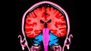 The image shows a brain scan seen from the dront of the head. The lobes of the brain are artifically coloured in bright red and you can see the pink outline of a person's skull around the brain. 