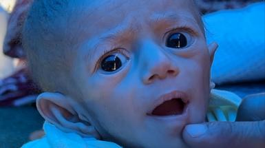 A malnourished baby looks at the camera with her mouth slightly open.