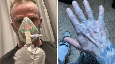 Split picture of Scott Lynch wearing an oxygen mask and another pic of his blue hand