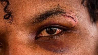 An alleged victim of a scam centre shows a cut above their eye