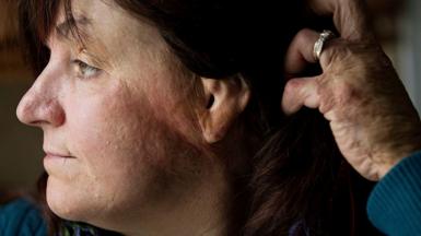 Gina Russo, a survivor of the 2003 Station nightclub fire, holds her hair behind her head as she shows her burn scars on the side of her face.