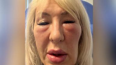 Andrea after her treatments. Her cheeks and lips are puffy and her eyes are barely open. She has shoulder-length blonde hair and is sitting in a blue medical chair