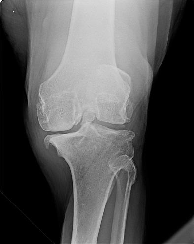 X-ray of knee joint