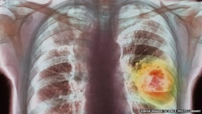 Coloured X-ray showing lung cancer