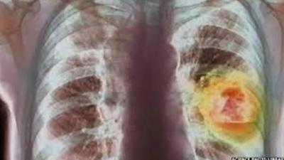 An x-ray showing lung cancer