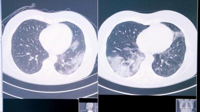 A lung scan