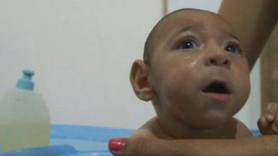 Baby with microcephaly being bathed