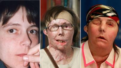 Carmen Blandin Tarleton shown before the attack (l), after the attack (m), and after her face transplant (r)