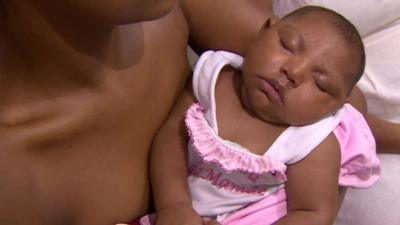 Baby in Brazil born with microcephaly.