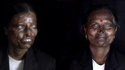 Mother and daughter - acid attack victims