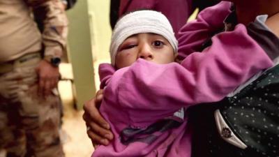 Child wounded in Mosul