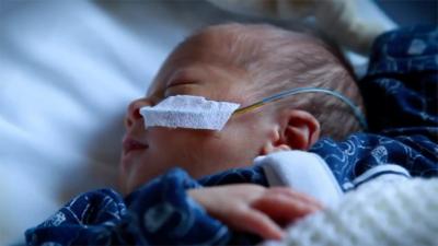 Baby Seth with a nasogastric tube