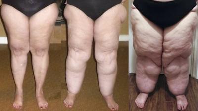 lipoedema