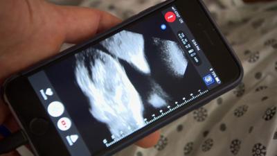 Butterfly ultrasound scanner