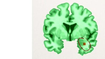 Scientists say that the brain structures of traumatised soldiers and children change in the same way.