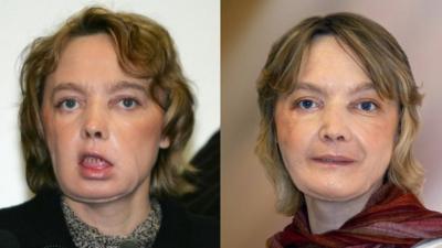Isabelle Dinoire in early 2006 and after further surgery eight months later