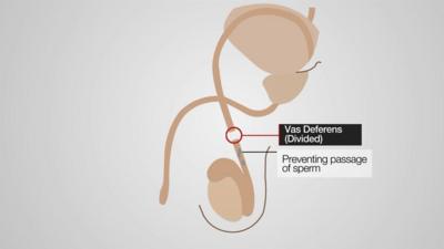 A graphic showing how a vasectomy works