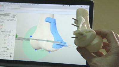 A 3D printed bone replacement and a 3D model displayed on a computer screen