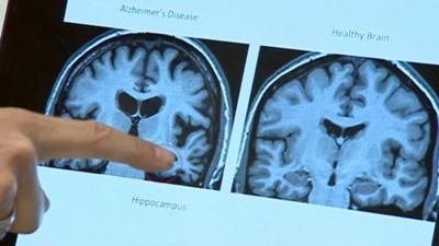 Scans of a brain with Alzheimer's (left) and a healthy brain