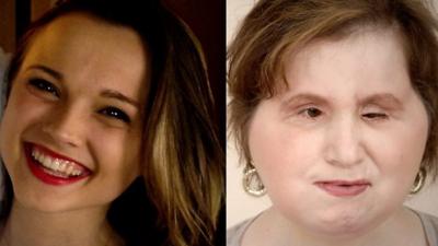 Katie and her parents describe what it has been like adjusting to life after she received a rare face transplant.