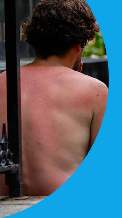 A man seen from behind with a red sunburnt back and arm. He's sat on a step with no top on.