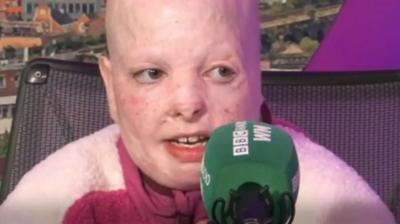 A young girl who has burn injuries on her face is speaking into a green microphone