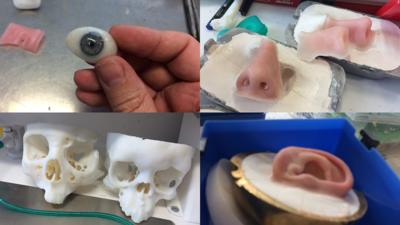 3D facial prosthetics