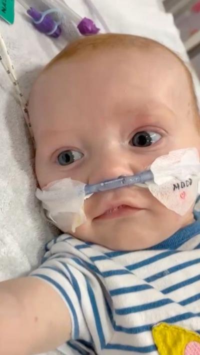 A baby with a tube up its nose and tape stapling the tube to its face. The baby is wearing a white top with blue horizontal stripes and has ginger hair