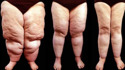 Lipoedema legs