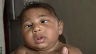 A baby whose mother had Zika and now has a smaller head than other children of a similar age