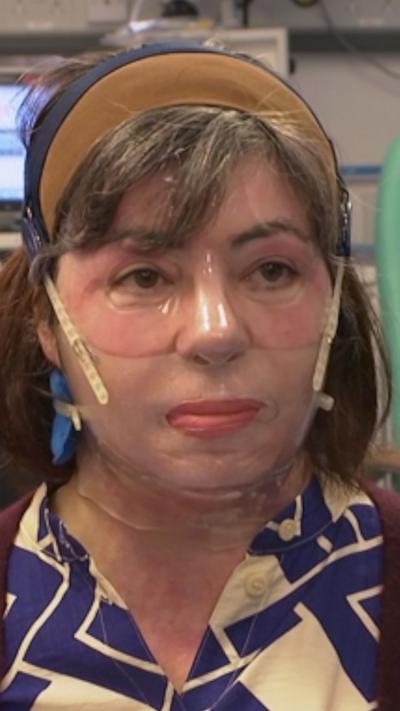 Woman with mask and eye protection following burns injury