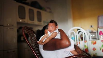 A 3-month-old baby in Recife, Brazil, who has microcephaly