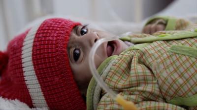 A malnourished baby being treated in hospital