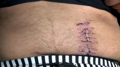 Stitches of man who sold his kidney