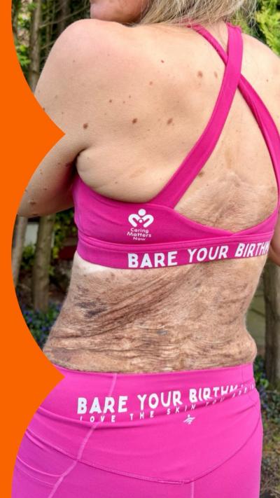 The exposed back of a woman in running gear, showing her birthmark. It is brown, hairy, and covers a large part of her back.