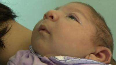 A baby born with microcephaly