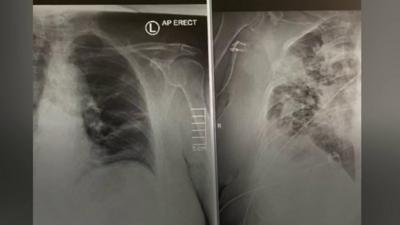 Lung X-ray