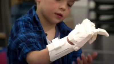 Boy with prosthetic hand