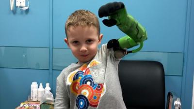 Little Jacob has a new prosthetic arm