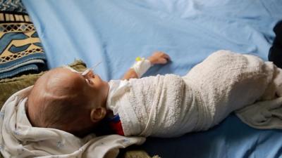 A starving child in a Yemeni hospital