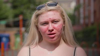 Abigail Collins showing the cystic acne without make-up