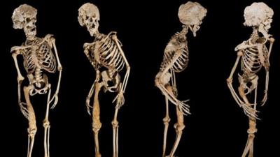 Joseph Merrick's skeleton