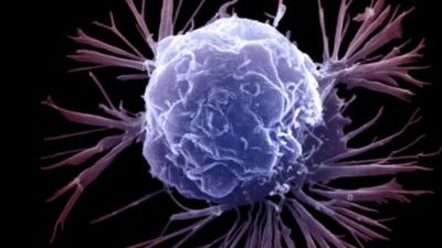 Breast cancer cell