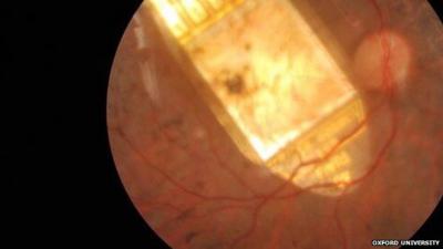 retinal implant