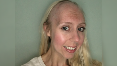 Katie Smith's hair loss following chemo