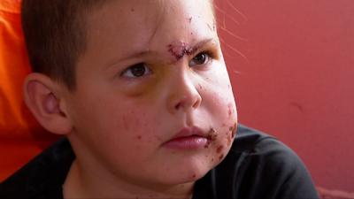 Bradley stiches above his nose and cuts on his cheeks and forehead